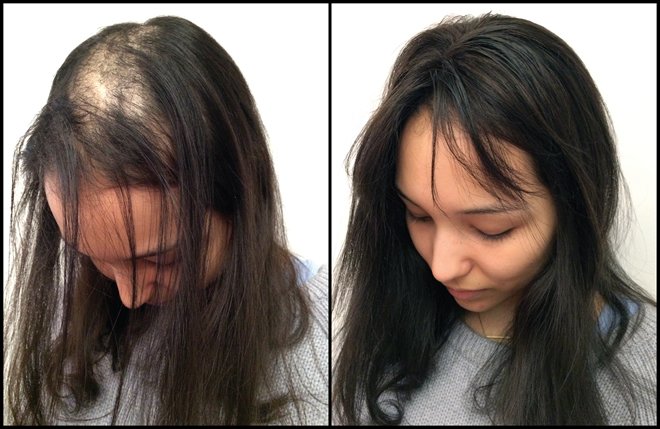 Topo De Cabeça (Cabelo Humano) - Para Alopecia, Falhas, Cabelos Ralos e com Queda 