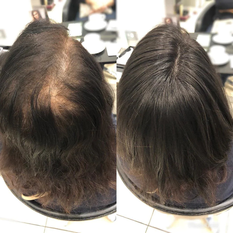 Topo De Cabeça (Cabelo Humano) - Para Alopecia, Falhas, Cabelos Ralos e com Queda 